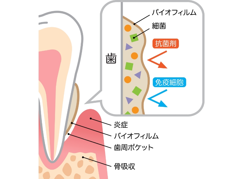 バイオフィルムが抗菌剤や免疫細胞から細菌を守り、歯周ポケットや炎症・骨吸収を招く仕組みのイラスト